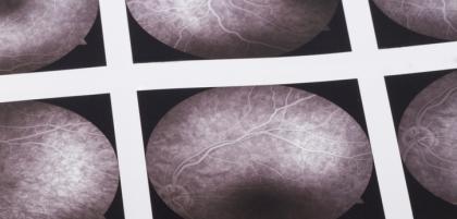 Na czym polega angiografia?