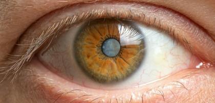 Czym jest kapsulotomia laserowa i jakie daje efekty?