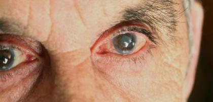 Zaćma – przyczyny, objawy i leczenie