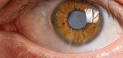 Jak przebiega zabieg usuwania zaćmy?