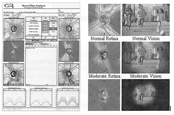Perymetria komputerowa