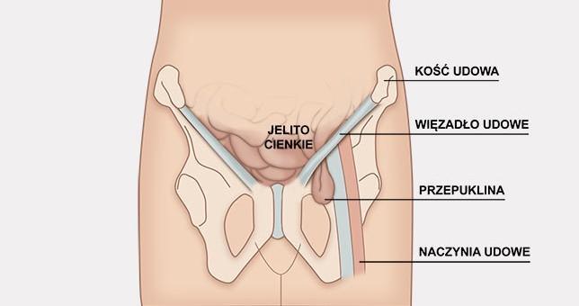 Obraz przepukliny pachwinowej 